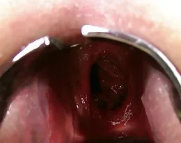 kinkyniky dubbel anal fisting framfall xo spekulum gapa